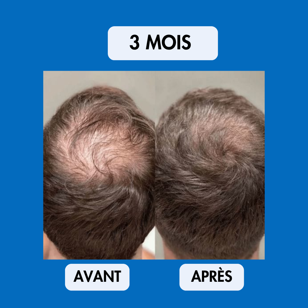 Sérum Repousse Sans Effets Secondaires – Nalhaa