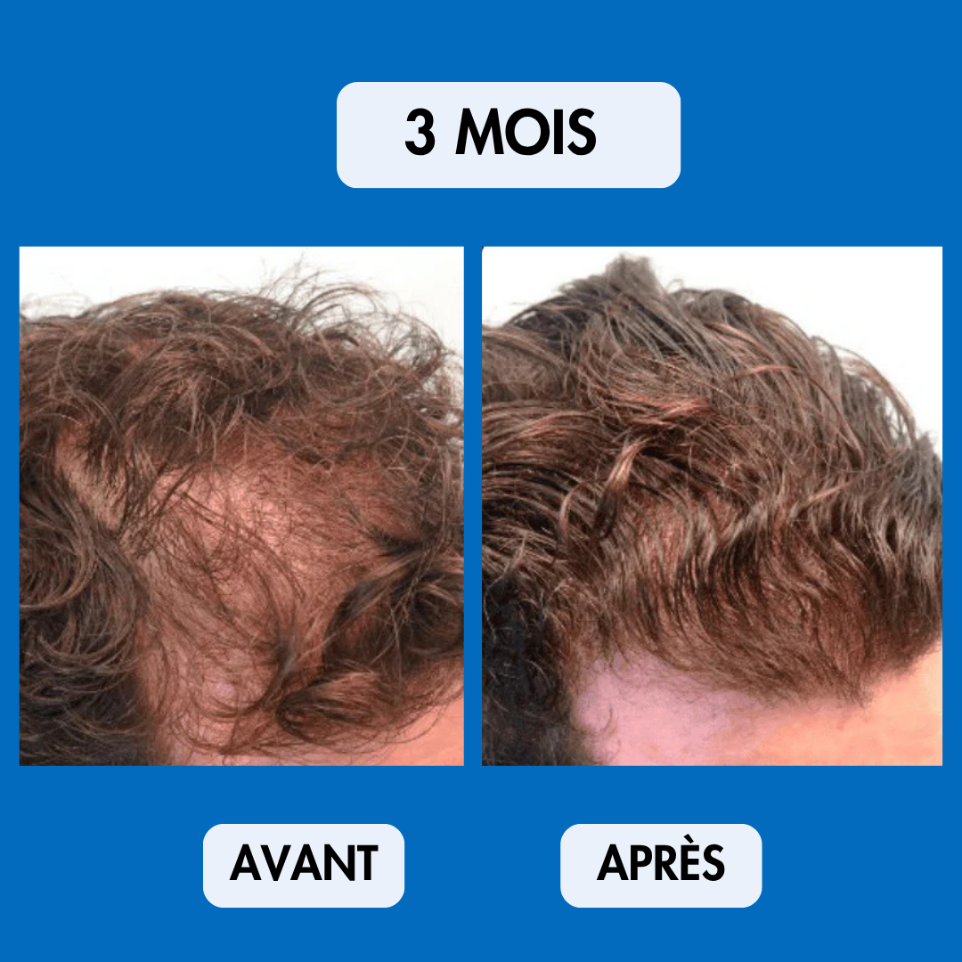 Sérum Repousse Sans Effets Secondaires – Nalhaa